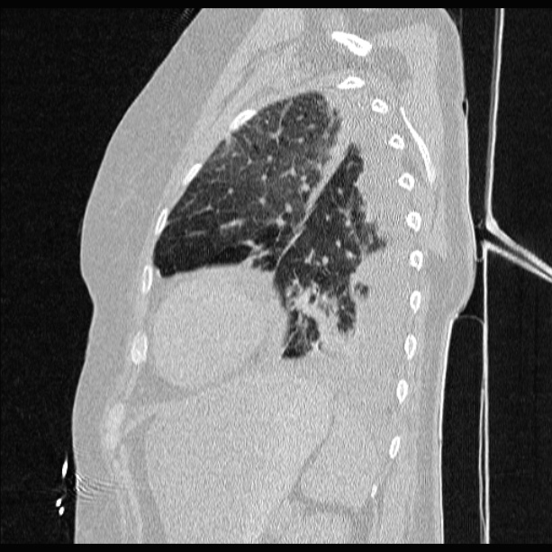 Cardiogenic pulmonary edema (Radiopaedia 29213-29609 Sagittal lung window 74).jpg
