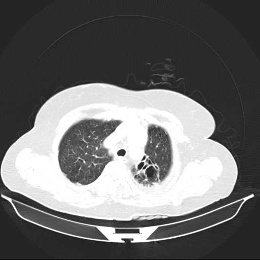 File:Carotid body tumor (Radiopaedia 21021-20948 Axial lung window 6).jpg