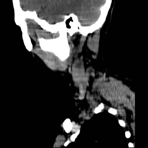 File:Carotid body tumor (Radiopaedia 27890-28124 C 1).jpg