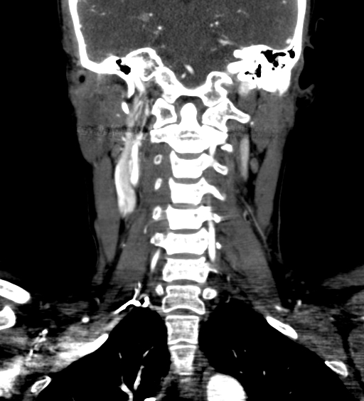 File:Carotid body tumor (Radiopaedia 39845-42300 C 60).jpg