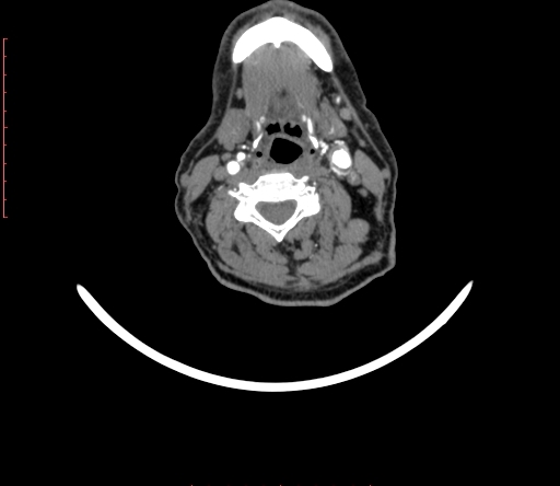 Carotid body tumor (Radiopaedia 66785-76116 B 52).jpg