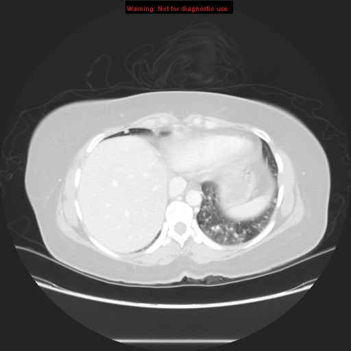 Carotid body tumor with lung metastases (Radiopaedia 9301-48390 Axial lung window 55).jpg