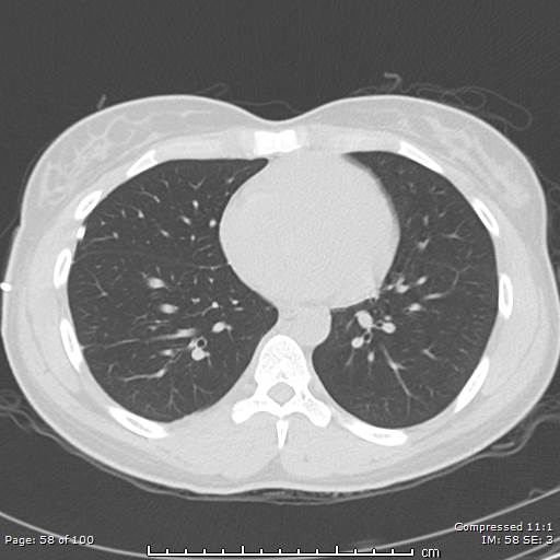 Catamenial pneumothorax (Radiopaedia 54382-60600 Axial non-contrast 58).jpg