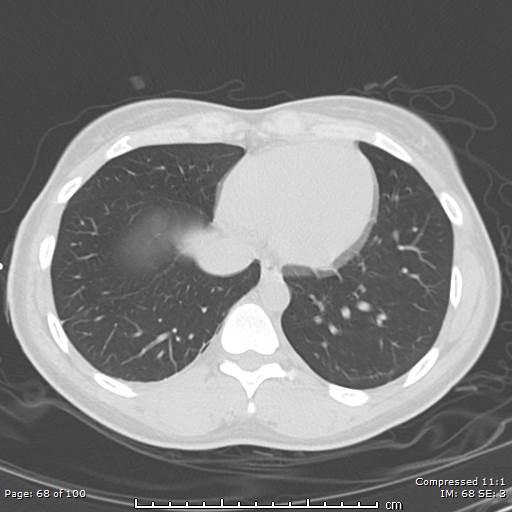File:Catamenial pneumothorax (Radiopaedia 54382-60600 Axial non-contrast 68).jpg