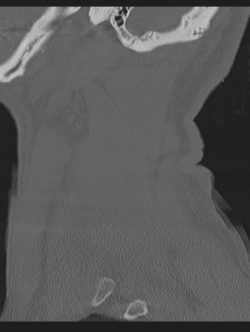 Cavernoma of cervical cord (Radiopaedia 50838-56346 Sagittal bone window 70).png