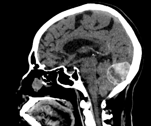 Cavernous hemangioma of the cerebellar falx (Radiopaedia 73025-83723 B 171).jpg