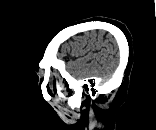 Cavernous hemangioma of the cerebellar falx (Radiopaedia 73025-83723 B 274).jpg