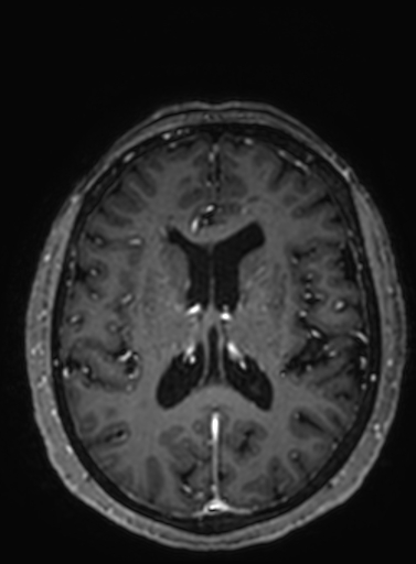 File:Cavernous hemangioma of the cerebellar falx (Radiopaedia 73025-83724 Axial T1 C+ 142).jpg