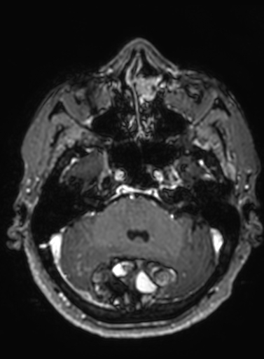 Cavernous hemangioma of the cerebellar falx (Radiopaedia 73025-83724 Axial T1 C+ 251).jpg