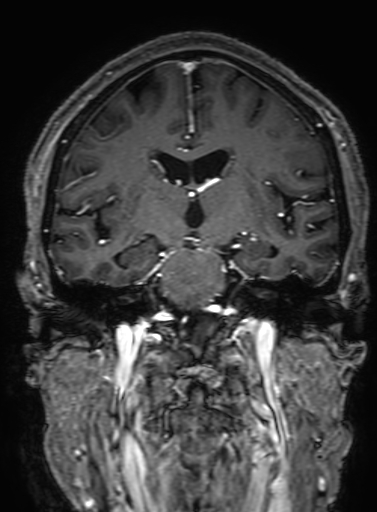 Cavernous hemangioma of the cerebellar falx (Radiopaedia 73025-83724 Coronal T1 C+ 194).jpg