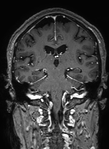 Cavernous hemangioma of the cerebellar falx (Radiopaedia 73025-83724 Coronal T1 C+ 220).jpg
