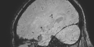 Cavernous hemangioma of the cerebellar falx (Radiopaedia 73025-83724 Sagittal BOLD 147).jpg