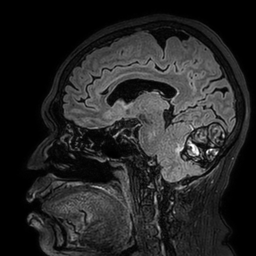 File:Cavernous hemangioma of the cerebellar falx (Radiopaedia 73025-83724 Sagittal FLAIR 122).jpg