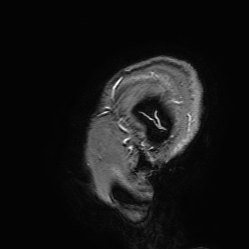 Cavernous hemangioma of the cerebellar falx (Radiopaedia 73025-83724 Sagittal T1 C+ 206).jpg