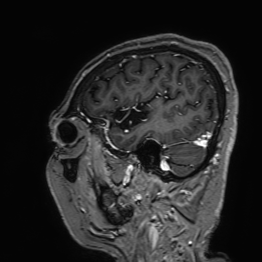 Cavernous hemangioma of the cerebellar falx (Radiopaedia 73025-83724 Sagittal T1 C+ 41).jpg