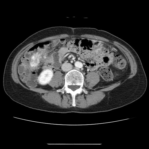 Cavernous hepatic hemangioma (Radiopaedia 75441-86667 B 66).jpg