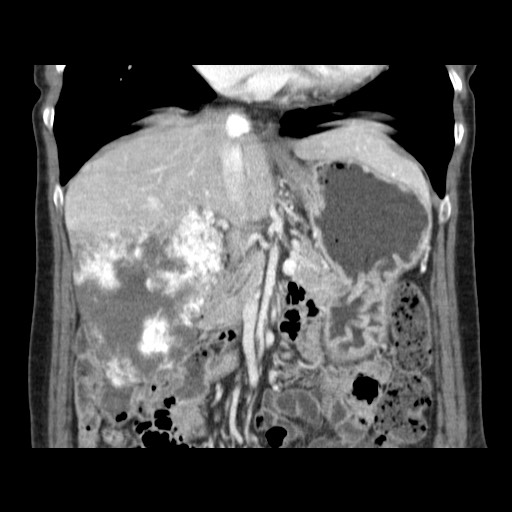 Cavernous hepatic hemangioma (Radiopaedia 75441-86667 C 62).jpg