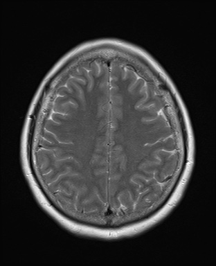 File:Cavernous sinus meningioma (Radiopaedia 63682-72367 Axial T2 17).jpg
