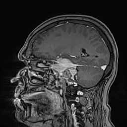 Cavernous sinus meningioma (Radiopaedia 63682-72367 Sagittal T1 C+ 72).jpg