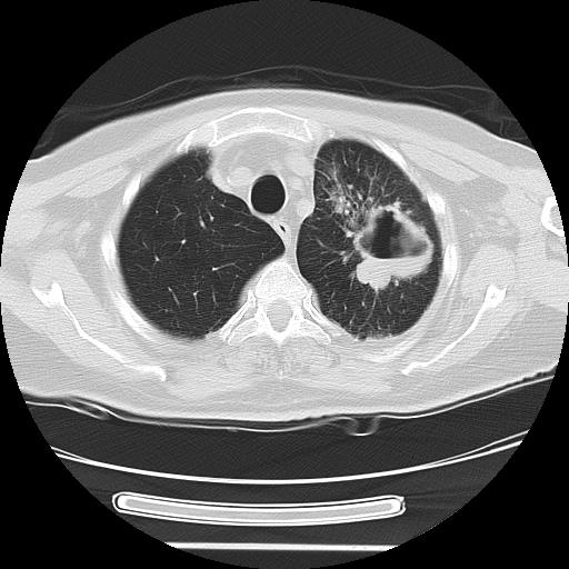 Cavitating pulmonary metastases (Radiopaedia 89545-106544 Axial lung window 11).jpg
