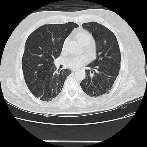 Cavitating pulmonary metastases (Radiopaedia 89545-106544 Axial lung window 31).jpg