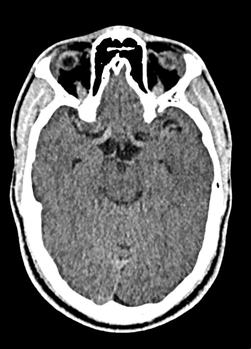 Cavum septum pellucidum and cavum vergae (Radiopaedia 77797-90060 Axial Brain Window 40).jpg