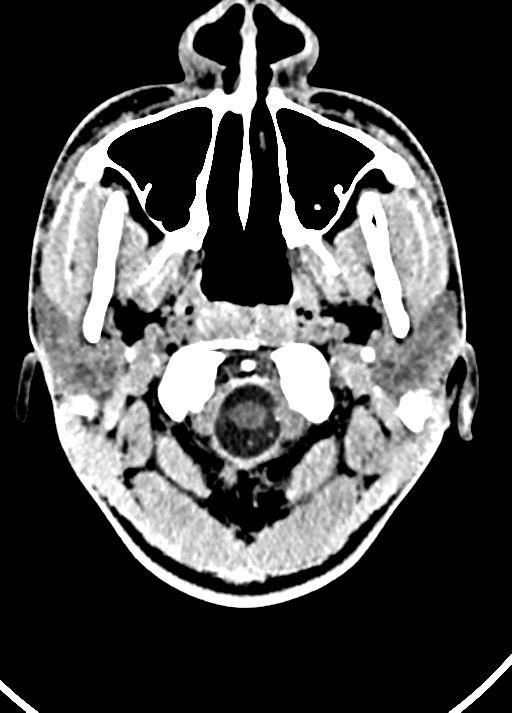 Cavum septum pellucidum and cavum vergae (Radiopaedia 77797-90060 Axial Brain Window 5).jpg
