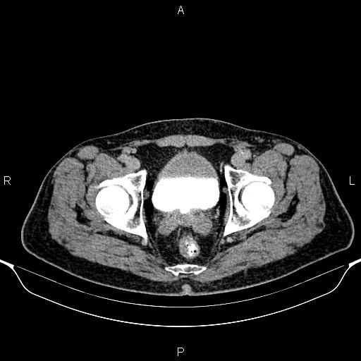 Cecal adenocarcinoma (Radiopaedia 85324-100916 Axial C+ delayed 94).jpg