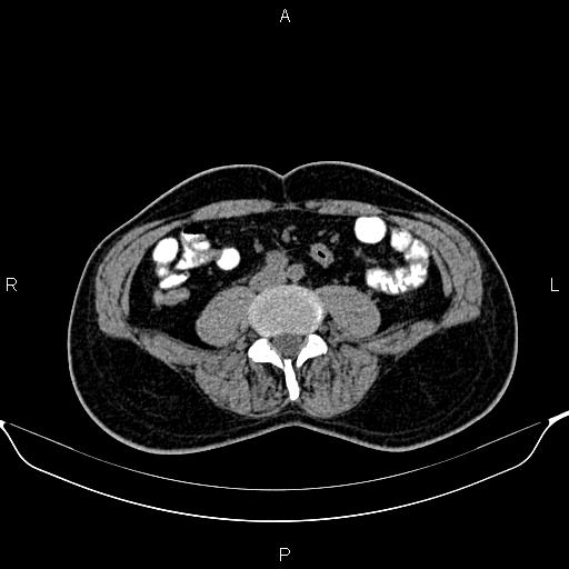 Cecal adenocarcinoma (Radiopaedia 85324-100916 Axial non-contrast 59).jpg