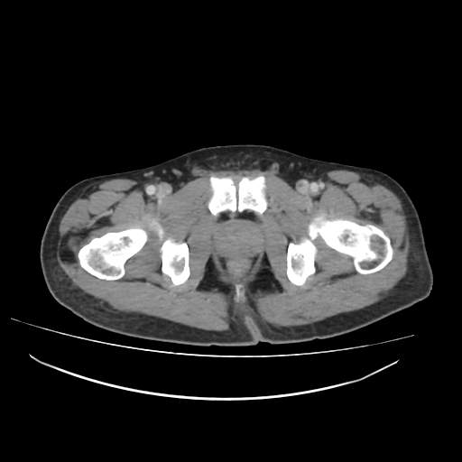 Cecal carcinoma with local lymphadenopathy (Radiopaedia 31428-32240 A 55).jpg