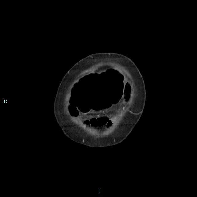 Cecal volvulus (Radiopaedia 71372-81698 C 9).jpg