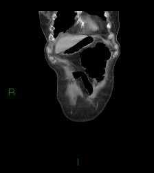 Cecal volvulus (Radiopaedia 86741-102900 B 70).jpg