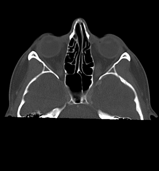 Cemento-ossifying fibroma (Radiopaedia 46243-50643 Axial bone window 19).png