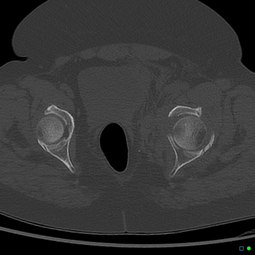 File:Central fracture-dislocation of the acetabulum (Radiopaedia 36578-38150 Axial bone window 58).jpg