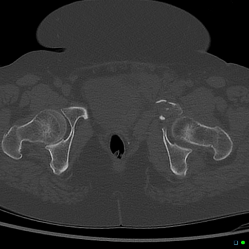 File:Central fracture-dislocation of the acetabulum (Radiopaedia 36578-38150 Axial bone window 69).jpg