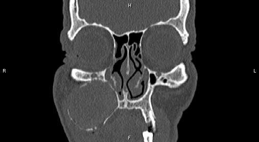 File:Central giant cell granuloma (Radiopaedia 83346-97761 Coronal bone window 8).jpg