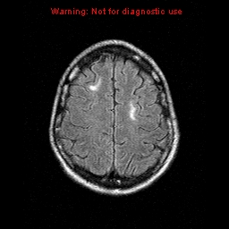 File:Central nervous system vasculitis (Radiopaedia 8410-9235 Axial FLAIR 20).jpg