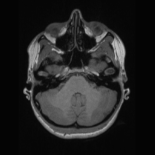File:Central neurocytoma (Radiopaedia 37664-39557 Axial T1 16).png