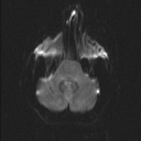 Central neurocytoma (Radiopaedia 56690-63469 Axial DWI 22).jpg