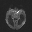 Central neurocytoma (Radiopaedia 56690-63469 Axial DWI 45).jpg