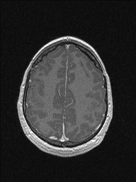 Central neurocytoma (Radiopaedia 56690-63469 Axial T1 C+ 132).jpg