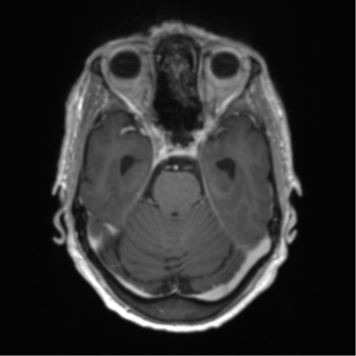 Central neurocytoma (Radiopaedia 65317-74345 Axial T1 C+ 15).png
