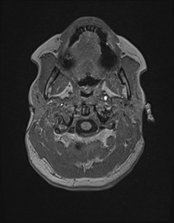 Central neurocytoma (Radiopaedia 84497-99872 Axial T1 20).jpg