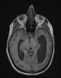 Central neurocytoma (Radiopaedia 84497-99872 Axial T1 83).jpg
