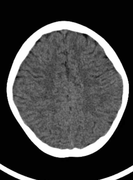 File:Cerebellar abscess (Radiopaedia 73727-84527 Axial non-contrast 50).jpg