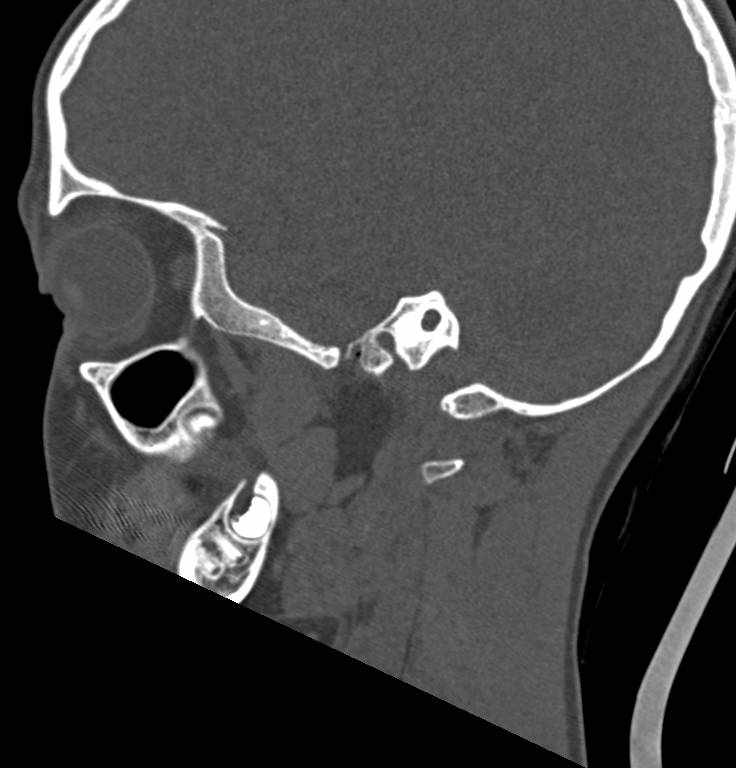 Cerebellar abscess (Radiopaedia 73727-84527 Sagittal bone window 4).jpg
