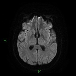Cerebellar abscess (Radiopaedia 78135-90678 Axial DWI 17).jpg