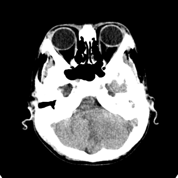 File:Cerebellar abscess secondary to mastoiditis (Radiopaedia 26284-26412 Axial non-contrast 31).jpg