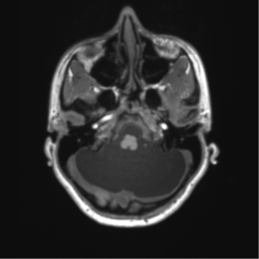 Cerebellar agenesis with hypoplastic pons (pontocerebellar hypoplasia) (Radiopaedia 57224-64138 Axial T1 19).png