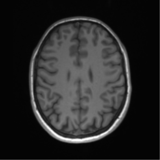 Cerebellar agenesis with hypoplastic pons (pontocerebellar hypoplasia) (Radiopaedia 57224-64138 Axial T1 53).png